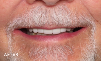 after photo of a patient's smile following treatment from Ankeny Dental Professionals in Ankeny, IA