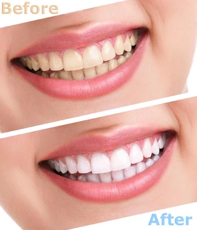 before and after of teeth whitening results at Ankeny Dental Professionals in Ankeny, IA