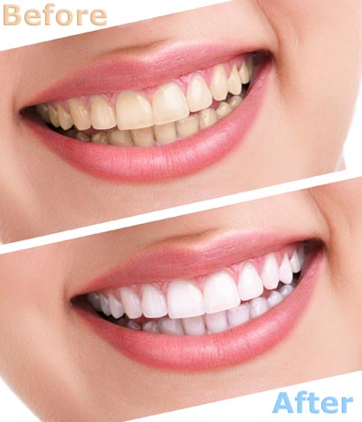 before and after of teeth whitening results at Ankeny Dental Professionals in Ankeny, IA
